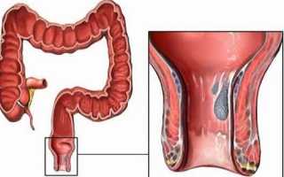 Может ли болеть спина из за трещин прямой кишки