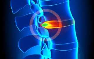 Почему болит спина в области лопаток и шеи