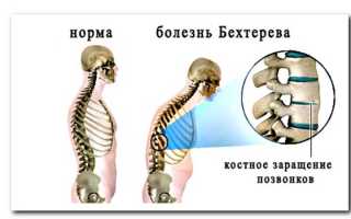 Ложусь на живот болит спина