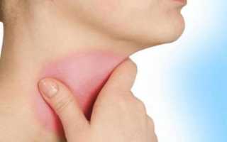 Болит голова и горло температуры нет что это