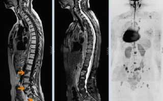 Метастазы в легких болит спина