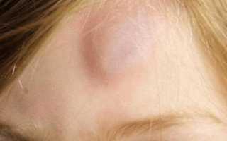 На голове шишка и болит при нажатии на него