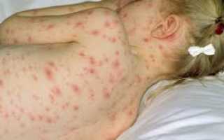 Ветрянка у детей болит голова