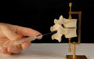 Спина может болеть при родах уколы на спине