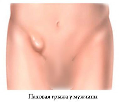паховая грыжа у мужчины