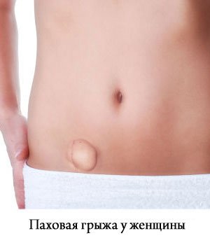 паховая грыжа у женщины