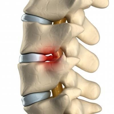 Сильно болит шея спина рука