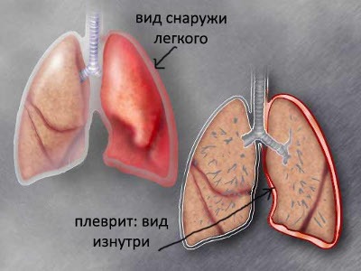 рвота болит правый бок и спина
