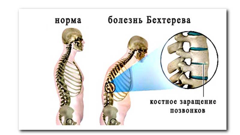 Что делать, болит спина в положении лежа