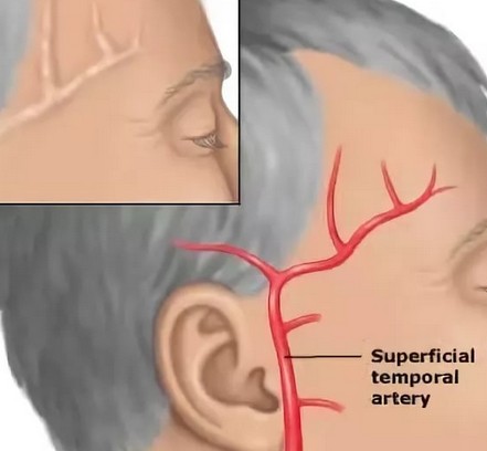 Почему часто болит правый висок головы