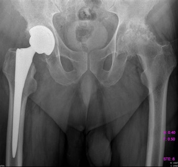 Болит спина отдает в правую ногу и пах