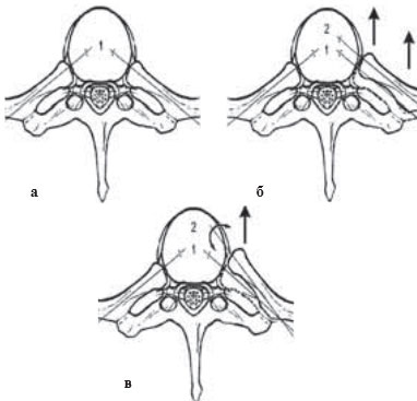 Межреберная невралгия симптомы лечение