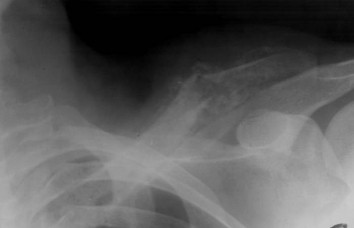 Болит правая ключица и отдает в голову