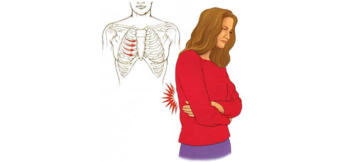 Межреберная невралгия