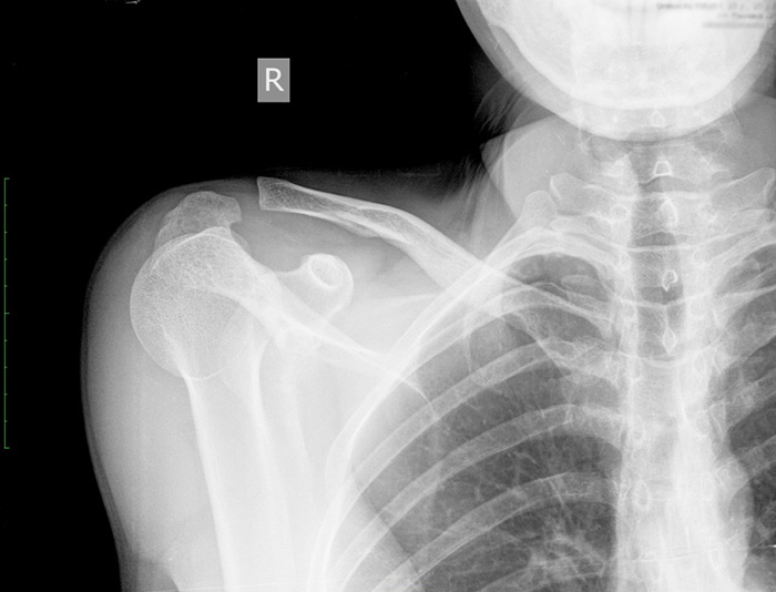 Болит правая ключица и отдает в голову