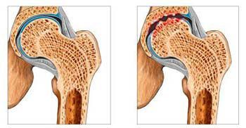 Дисфункции тазобедренных суставов