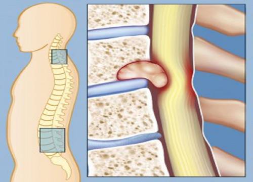 Метастазы в позвоночнике
