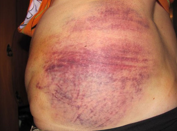 Ударилась спиной болит почка