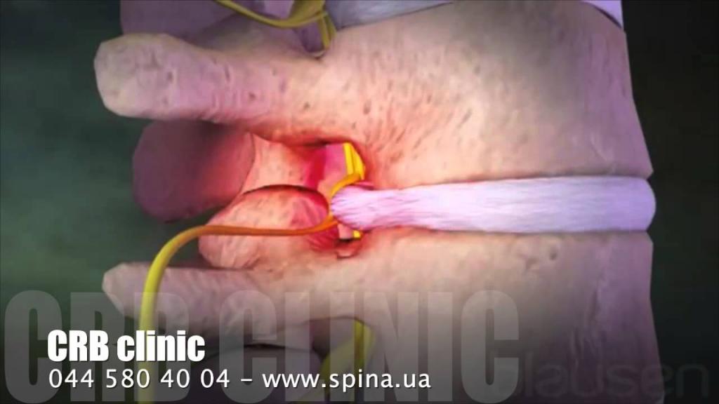 Болит низ спины где позвоночник