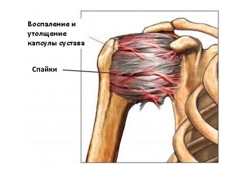 Адгезивный капсулит плеча