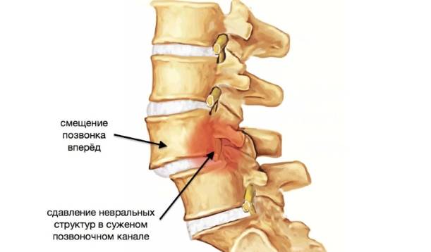 Смещение позвонков, вызванное травмой или поднятием тяжестей, приводит к защемлению нервных волокон и сосудов в позвоночном канале