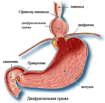 Диафрагмальная грыжа