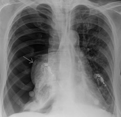 рвота болит правый бок и спина