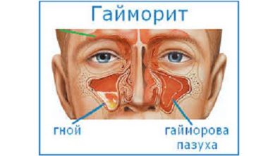 От температуры может болеть спина