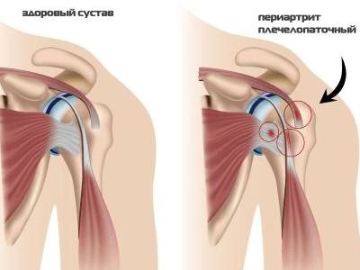 Сильно болит шея спина рука