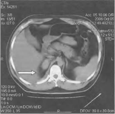 рвота болит правый бок и спина
