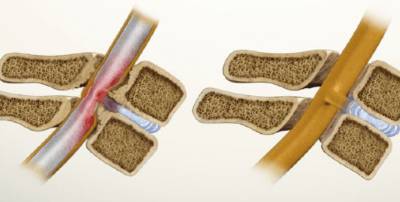 Болит спина отдает в правую ногу и пах