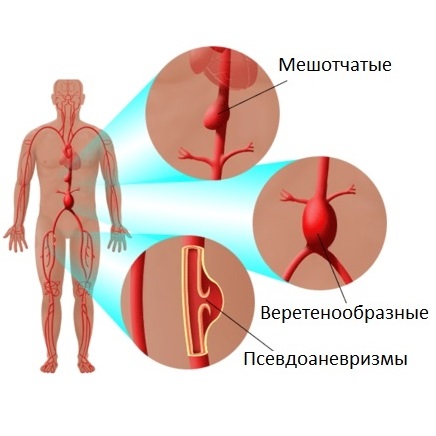 Виды аневризмы аорты
