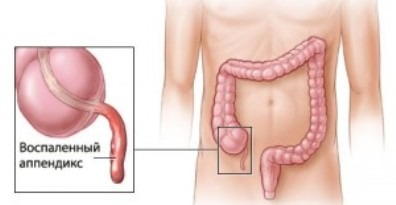 Болит голова спина живот тошнит