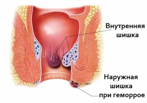 Когда сижу или лежу на спине болит копчик
