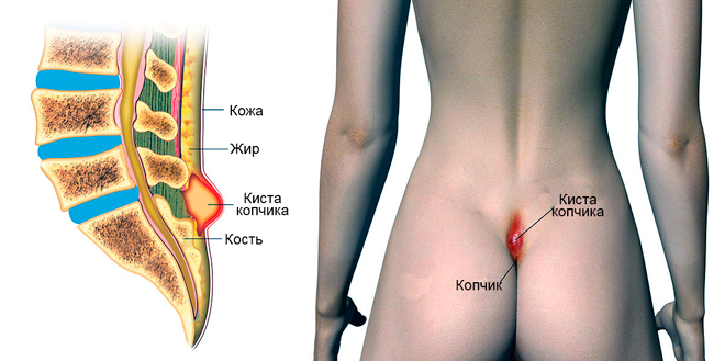 Когда сижу или лежу на спине болит копчик