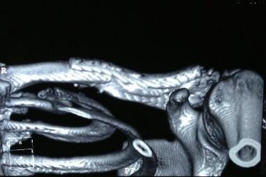 Болит правая ключица и отдает в голову