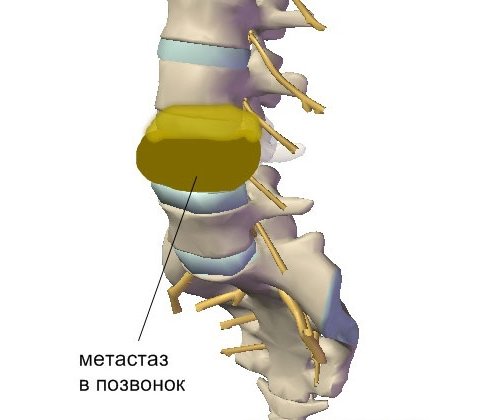 Метастаз в позвоночнике