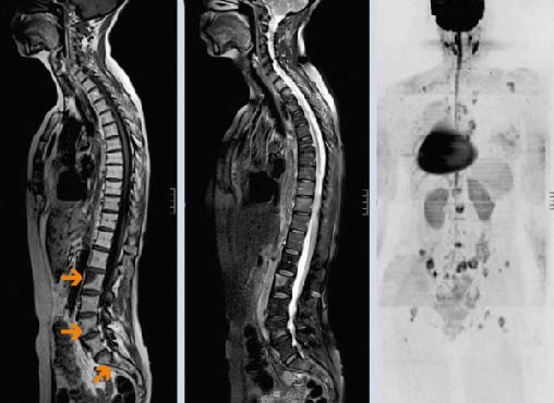 метастазы в легких болит спина