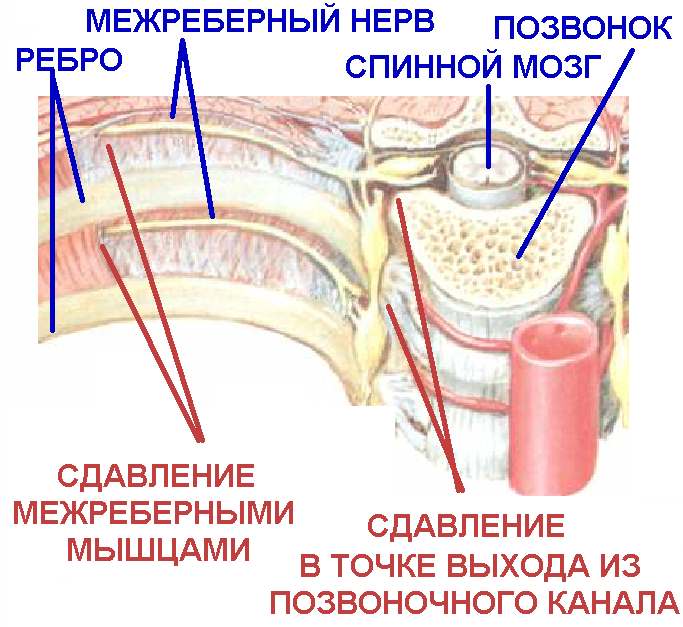Межреберная невралгия