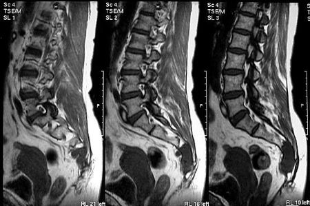 Когда сижу или лежу на спине болит копчик