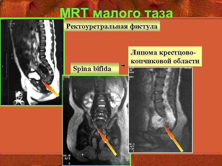 Когда сижу или лежу на спине болит копчик