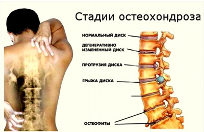 Болят суставы спина поясница ноги шея