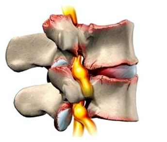 Сильно болит шея спина рука