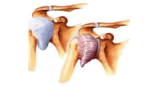 Плечелопаточный периартрит