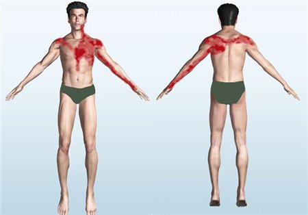 Распространение боли при инфаркте