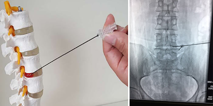 метастазы в легких болит спина