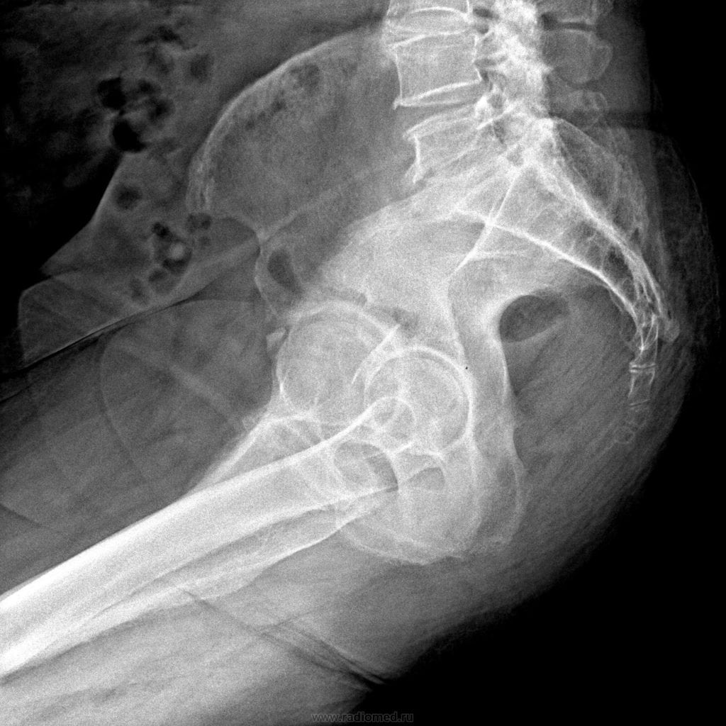 Когда сижу или лежу на спине болит копчик