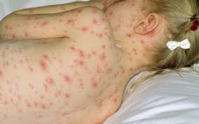 Как справиться с головной болью при ветрянке